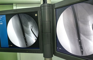 В Сургутской травмбольнице прооперировали 92-летнюю пациентку с тяжелым переломом