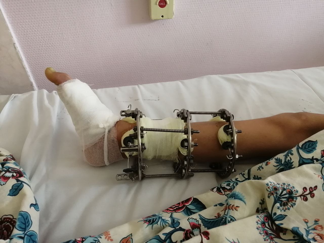 робот наложил гипс на здоровую ногу. перелом пяточной кости гипсовая лонгета. робот наложил гипс на здоровую ногу. робот наложил гипс на здоровую ногу. робот наложил гипс на здоровую ногу.