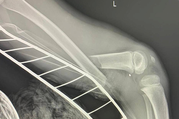 Едва не остался без ноги на карусели. 6-летнего пациента совместно спасали врачи Сургутской травмбольницы и СОКБ