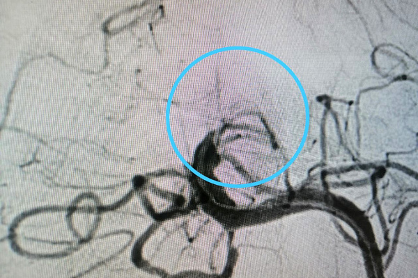 Крайняя мера. Редкую и рискованную операцию на сосудах головного мозга выполнили рентгенохирурги Сургутской травмбольницы