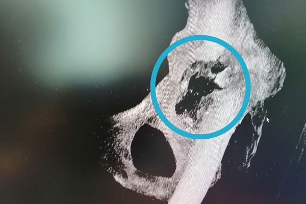 В Сургутской травмбольнице впервые установили 3D-эндопротез, изготовленный по индивидуальным параметрам пациента