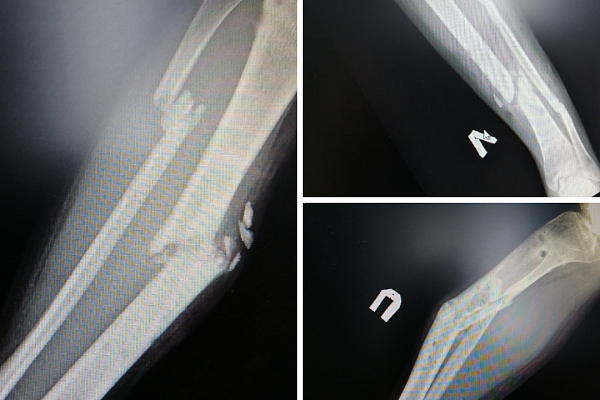 Травматологи Сургута спасают от тяжелой инвалидности 20-летнего югорчанина с переломами обеих ног