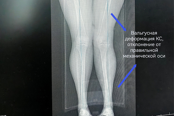 Второй шанс родному суставу. В Сургутской травмбольнице пациентку избавили от болей в колене без эндопротезирования