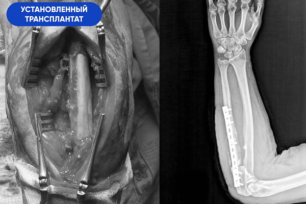 В Сургутской травмбольнице бойцу СВО пересадили фрагмент кости из голени в предплечье, чтобы спасти руку после ранения 
