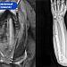 В Сургутской травмбольнице бойцу СВО пересадили фрагмент кости из голени в предплечье, чтобы спасти руку после ранения 