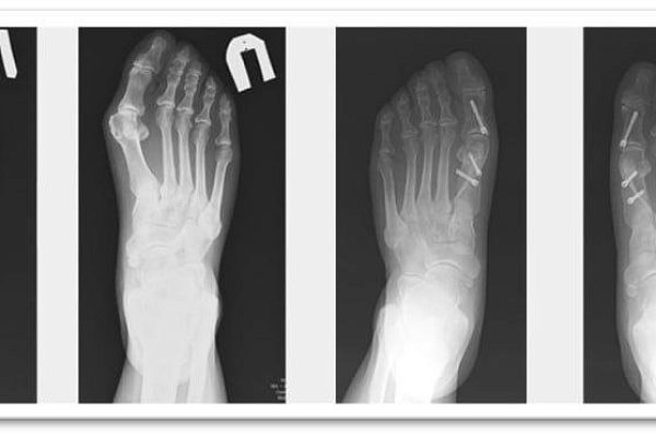 Красота требует, мы исполняем. Наращиваем объёмы высокотехнологичных реконструктивных операций при Hallux Valgus