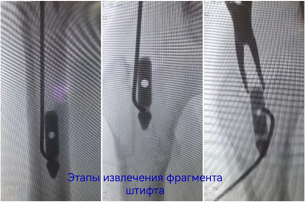 Уже не дети, но ещё не взрослые. Об особенностях лечения травм в подростковом возрасте