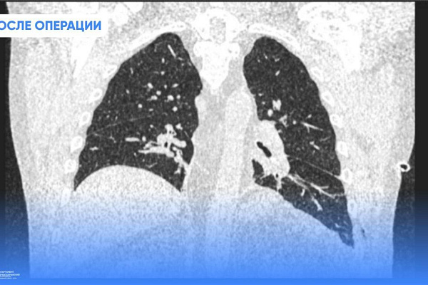 Редкий диагноз, редкая операция. Торакальные хирурги Сургутской травмбольницы выполнили пластику диафрагмы 64-летнему пациенту 