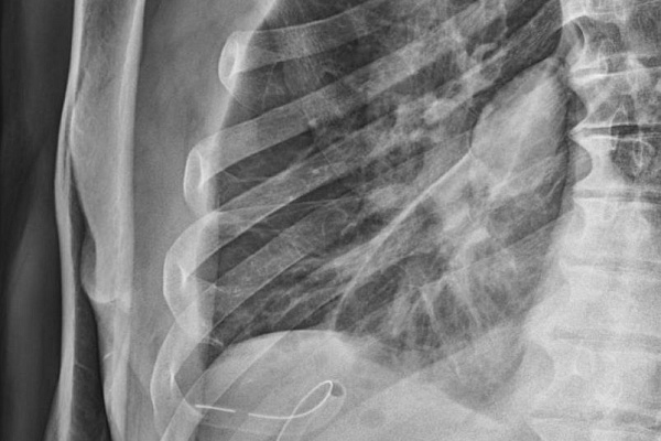 Торакальные хирурги Сургутской травмбольницы поставили на поток высокотехнологичное оперативное лечение гнойных воспалений плевры