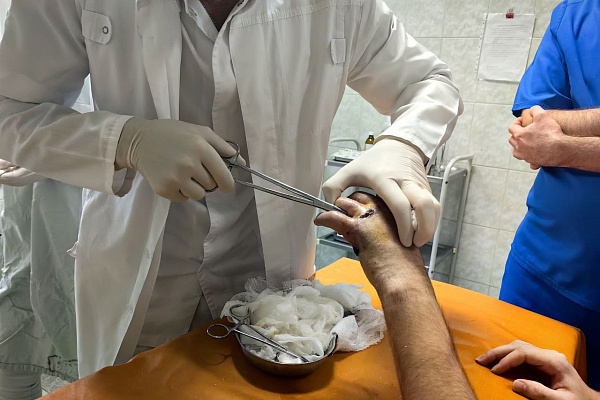 Пациенту Сургутской травмбольницы восстановили кисть после полной травматической ампутации целого сегмента с четырьмя пальцами