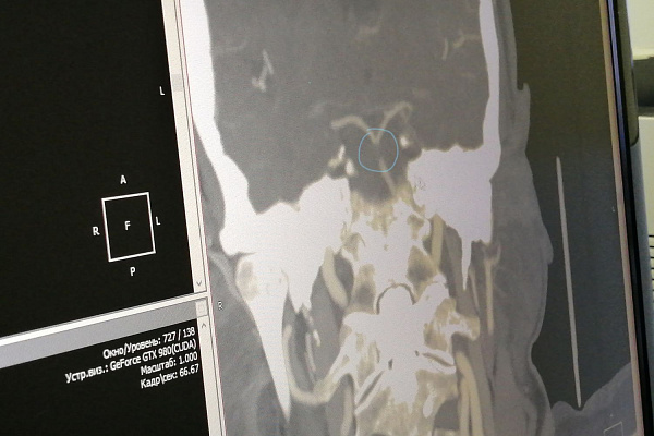 Зашла в магазин – очнулась в реанимации. Сургутской пенсионерке удалось избежать тяжелейших последствий тромбоэмболии основной артерии головного мозга