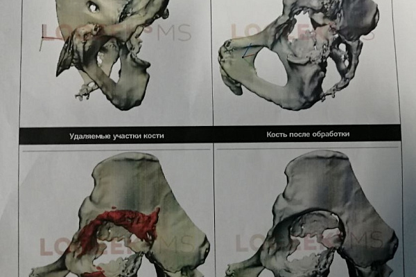 В Сургутской травмбольнице впервые установили 3D-эндопротез, изготовленный по индивидуальным параметрам пациента