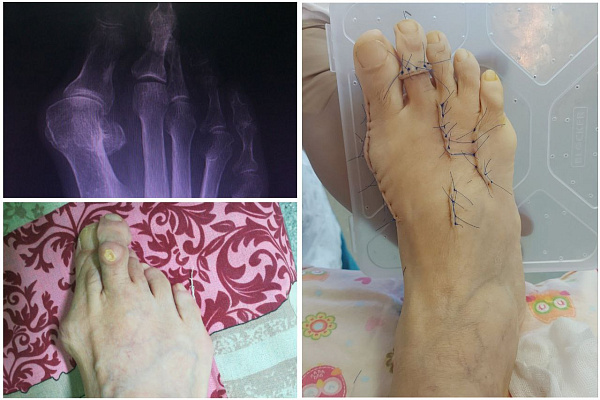 Красота требует, мы исполняем. Наращиваем объёмы высокотехнологичных реконструктивных операций при Hallux Valgus