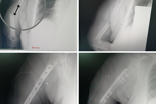 Когда другие не берутся. Сургутские травматологи-ортопеды нашли способы помочь гостьям Югры с тяжелыми травмами 