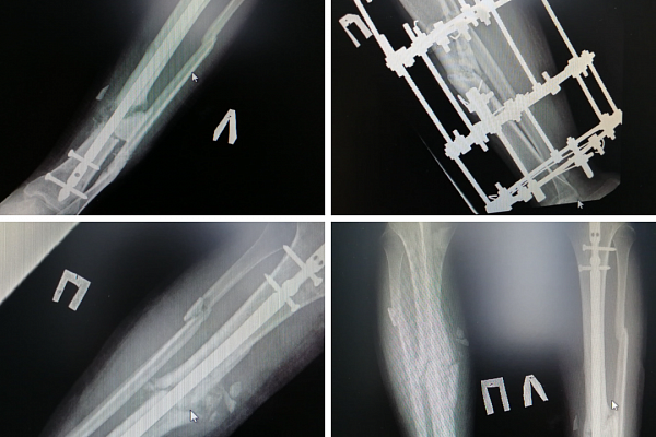 Травматологи Сургута спасают от тяжелой инвалидности 20-летнего югорчанина с переломами обеих ног