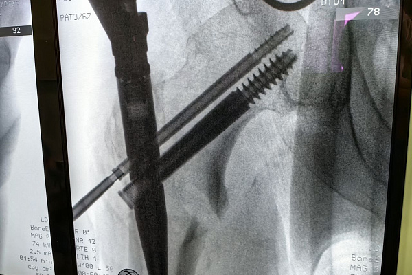 Два инсульта, и оба - с переломами. В Сургутской травматологической больнице повторно ставят на ноги 55-летнего мужчину 