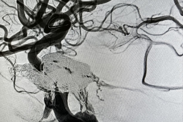 Разрыв сонной артерии от удара футбольным мячом. Рентгенохирурги травмбольницы спасли пациента с опасным повреждением сосудов головного мозга
