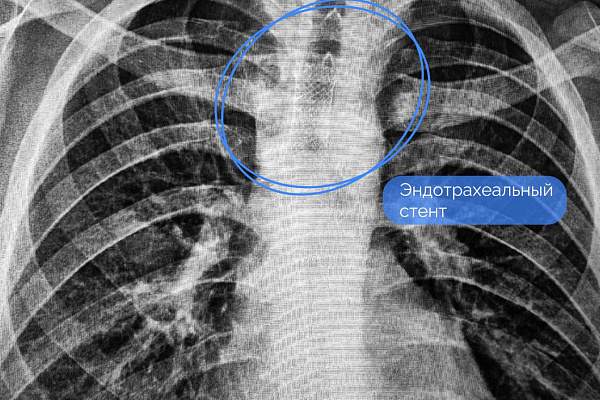 Торакальные хирурги Сургутской травмбольницы впервые столкнулись с послеоперационной перфорацией трахеи