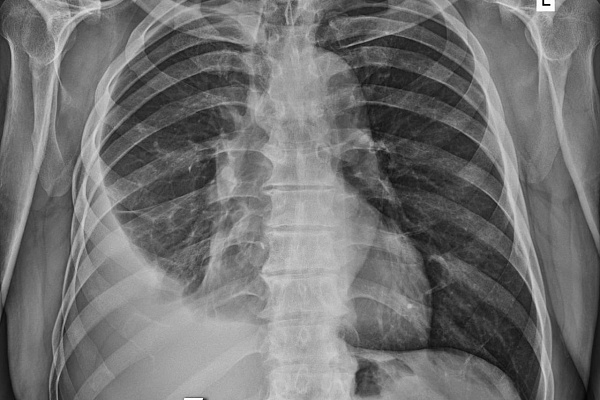 Торакальные хирурги Сургутской травмбольницы поставили на поток высокотехнологичное оперативное лечение гнойных воспалений плевры