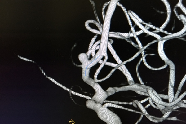 Редкий случай, тонкая работа. Рентгенохирургам травмбольницы пришлось одновременно стентировать сонную артерию и эмболизировать аневризму пожилому пациенту 