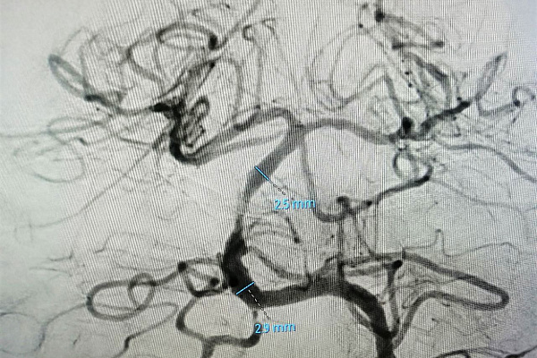 Крайняя мера. Редкую и рискованную операцию на сосудах головного мозга выполнили рентгенохирурги Сургутской травмбольницы