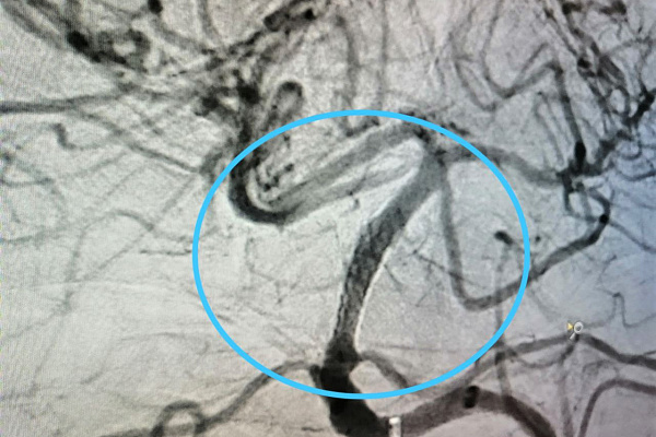 Крайняя мера. Редкую и рискованную операцию на сосудах головного мозга выполнили рентгенохирурги Сургутской травмбольницы