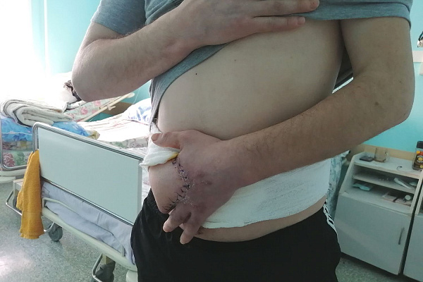 Зачем пациенту Сургутской травмбольницы пришили руку к животу? На что ещё идут хирурги, чтобы восстановить целостность кожного покрова на повреждённых участках