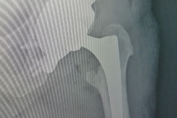 В Сургутской травмбольнице впервые установили 3D-эндопротез, изготовленный по индивидуальным параметрам пациента