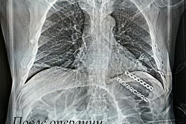 Извлекать лёгкое из межрёберного пространства пришлось торакальным хирургам Сургутской травмбольницы пациенту с тяжелой производственной травмой