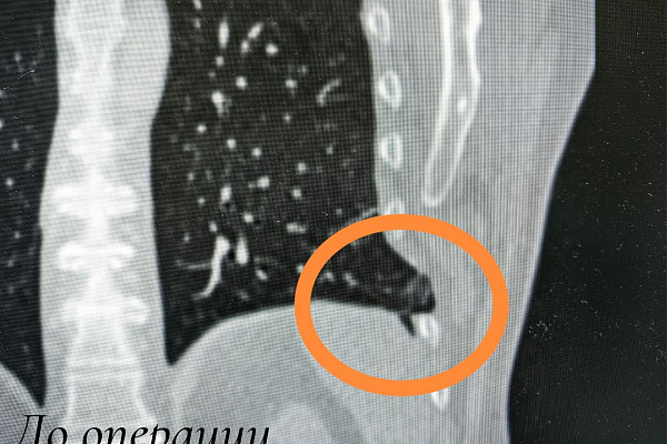 Извлекать лёгкое из межрёберного пространства пришлось торакальным хирургам Сургутской травмбольницы пациенту с тяжелой производственной травмой