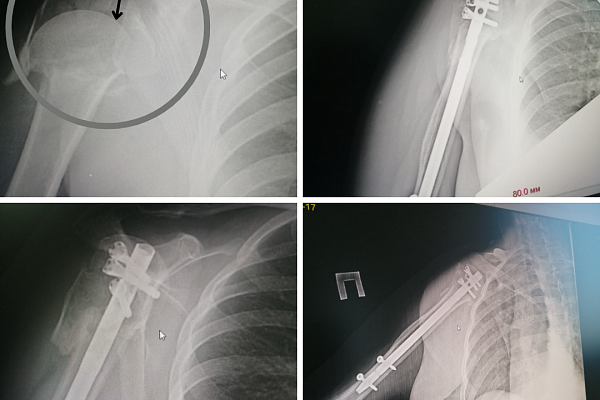 Когда другие не берутся. Сургутские травматологи-ортопеды нашли способы помочь гостьям Югры с тяжелыми травмами 