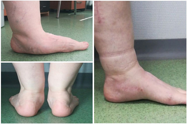 Красота требует, мы исполняем. Наращиваем объёмы высокотехнологичных реконструктивных операций при Hallux Valgus