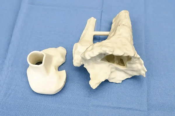 В Сургутской травмбольнице впервые выполнили эндопротезирование коленного сустава с установкой 3D-импланта