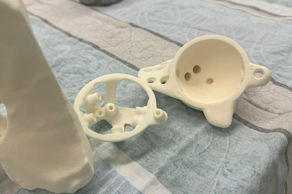 В Сургутской травмбольнице впервые установили 3D-эндопротез, изготовленный по индивидуальным параметрам пациента