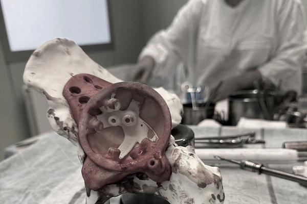 В Сургутской травмбольнице впервые установили 3D-эндопротез, изготовленный по индивидуальным параметрам пациента