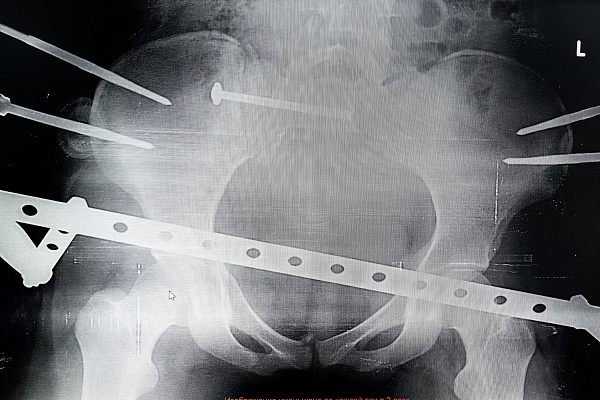 В Сургутской травмбольнице после тяжелой дорожно-транспортной травмы восстанавливается несовершеннолетняя пациентка 