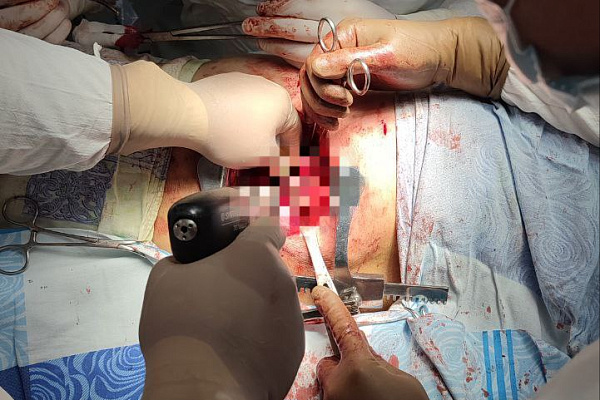 Извлекать лёгкое из межрёберного пространства пришлось торакальным хирургам Сургутской травмбольницы пациенту с тяжелой производственной травмой