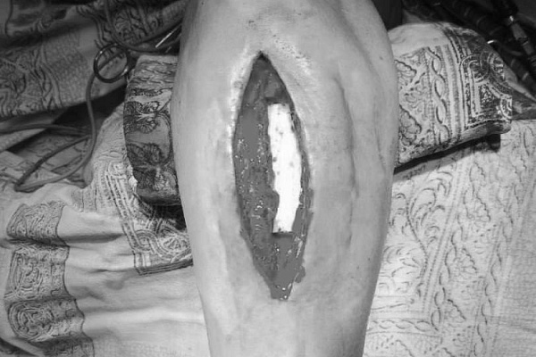 В Сургутской травмбольнице бойцу СВО пересадили фрагмент кости из голени в предплечье, чтобы спасти руку после ранения 