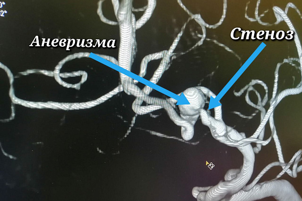 Должна была оставаться в сознании. Пациентка травмбольницы без наркоза перенесла операцию на сосудах головного мозга 