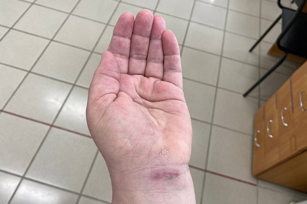 В Сургутской травмбольнице  начали выполнять уникальные для Югры малоинвазивные вмешательства при карпальном туннельном синдроме 