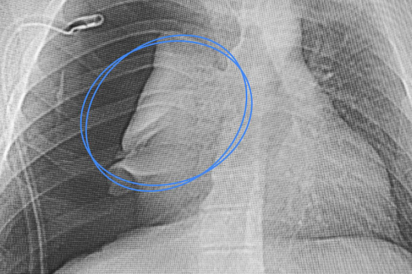 Торакальные хирурги Сургутской травмбольницы впервые столкнулись с послеоперационной перфорацией трахеи