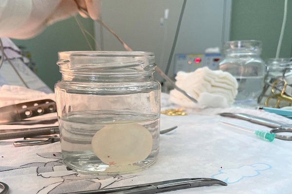 Три крупных паразитарных кисты с личинками эхинококка извлекли детские нейрохирурги Сургутской травмбольницы из головы юной пациентки 