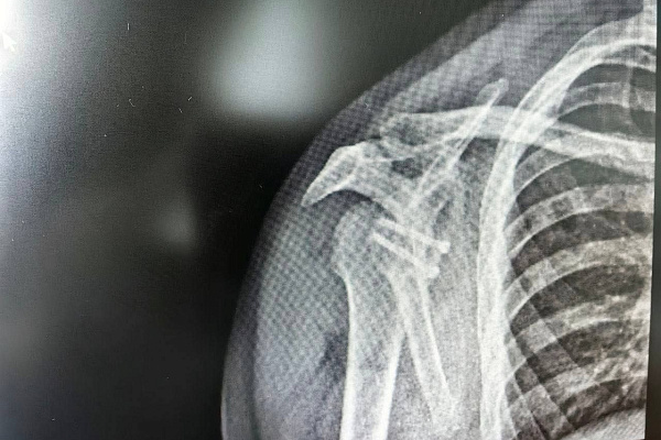 Больше 20 вывихов плеча перенёс спортсмен из Ханты-Мансийска, пока не обратился к врачам. В травмбольнице устранили причину нестабильности сустава