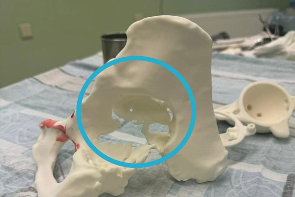 В Сургутской травмбольнице впервые установили 3D-эндопротез, изготовленный по индивидуальным параметрам пациента
