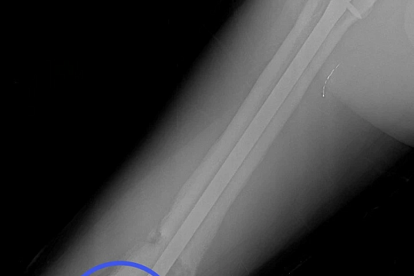 Уже не дети, но ещё не взрослые. Об особенностях лечения травм в подростковом возрасте