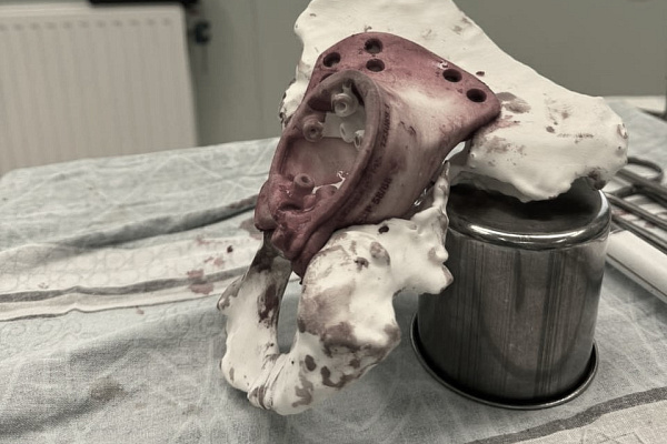 В Сургутской травмбольнице впервые установили 3D-эндопротез, изготовленный по индивидуальным параметрам пациента