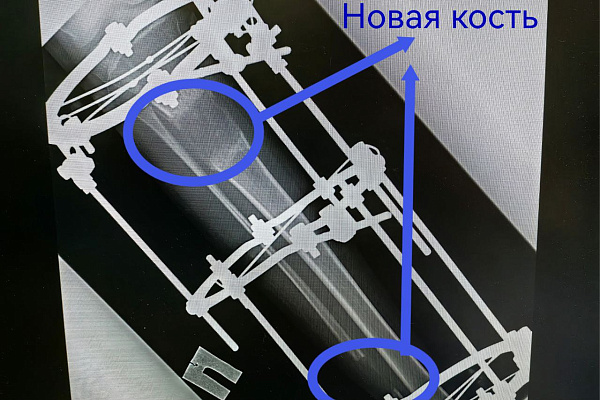 В Сургутской травмбольнице увеличивают объёмы высокотехнологичного лечения деформаций конечностей у детей 