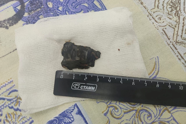 Хирурги Сургутской травмбольницы и Сургутской окружной клинической больницы совместно удалили осколок снаряда участнику СВО