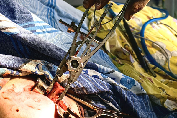 Больше 20 вывихов плеча перенёс спортсмен из Ханты-Мансийска, пока не обратился к врачам. В травмбольнице устранили причину нестабильности сустава