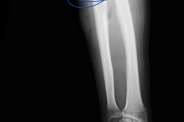 В Сургутской травмбольнице бойцу СВО пересадили фрагмент кости из голени в предплечье, чтобы спасти руку после ранения 